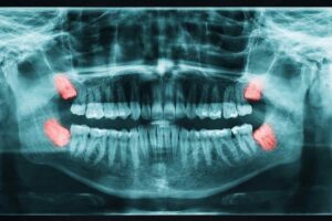 Best Time to Remove Wisdom Teeth