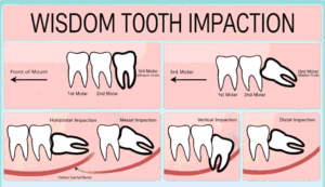 Best Time to Remove Wisdom Teeth