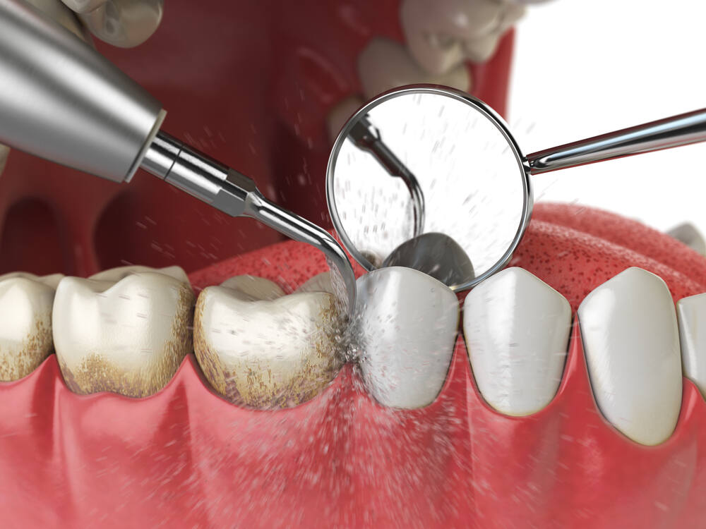 Dental Cleaning