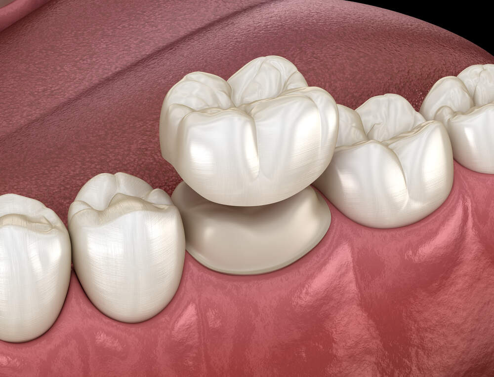 Dental Crowns