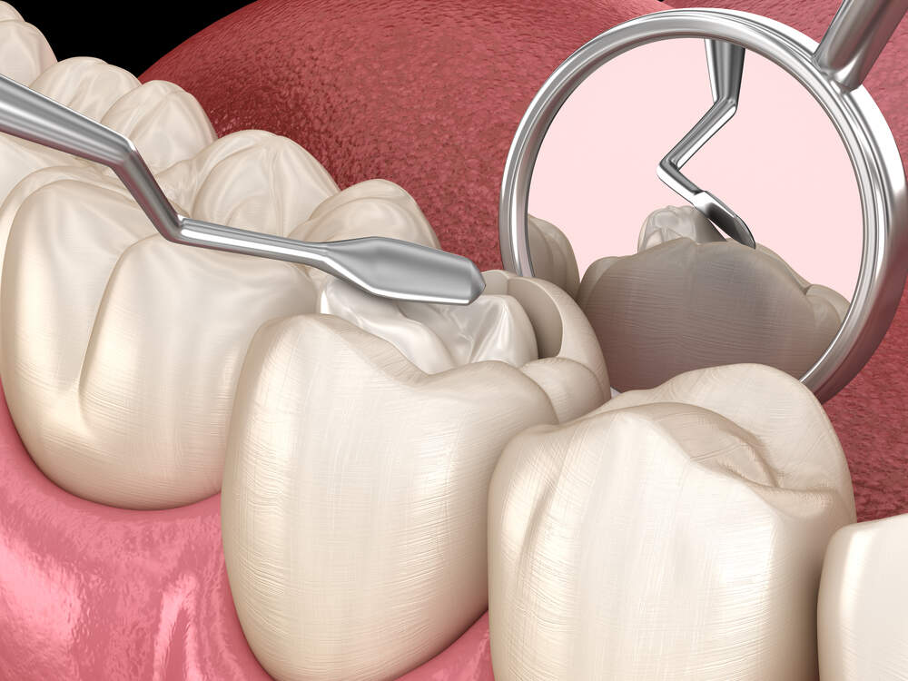 Dental Fillings