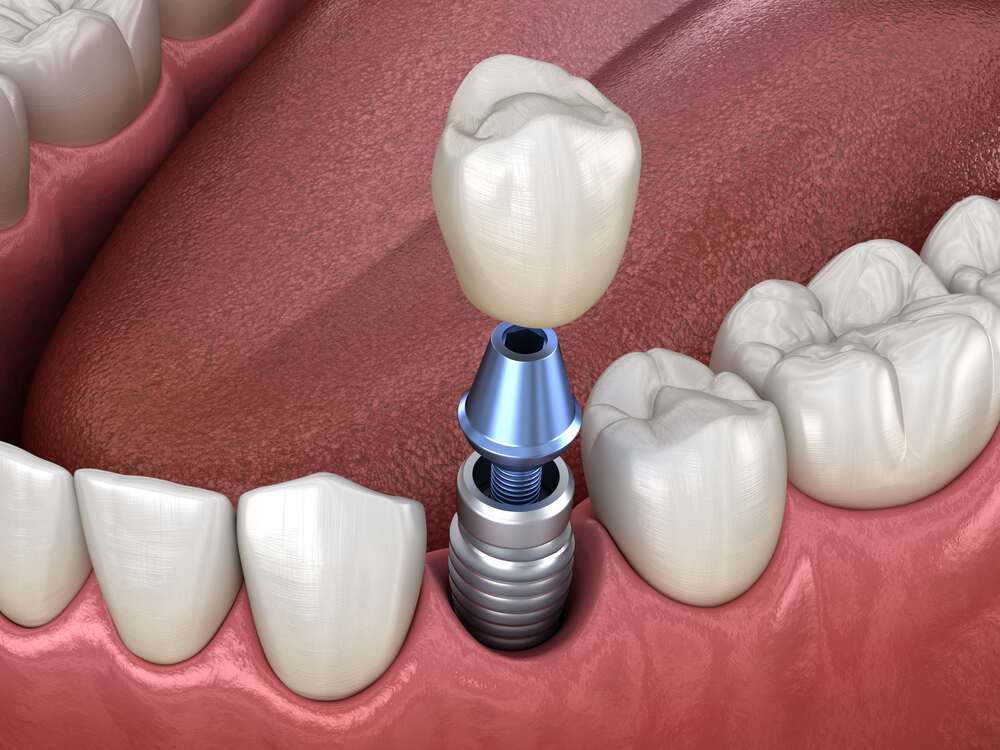 Dental Implants Procedure