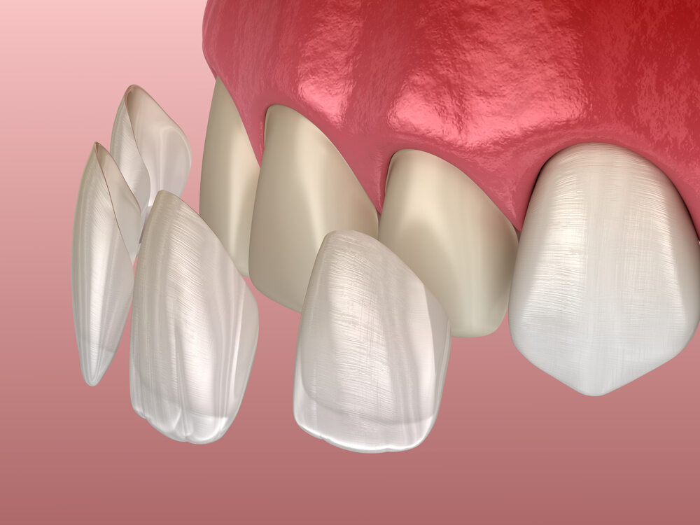 Dental Venners