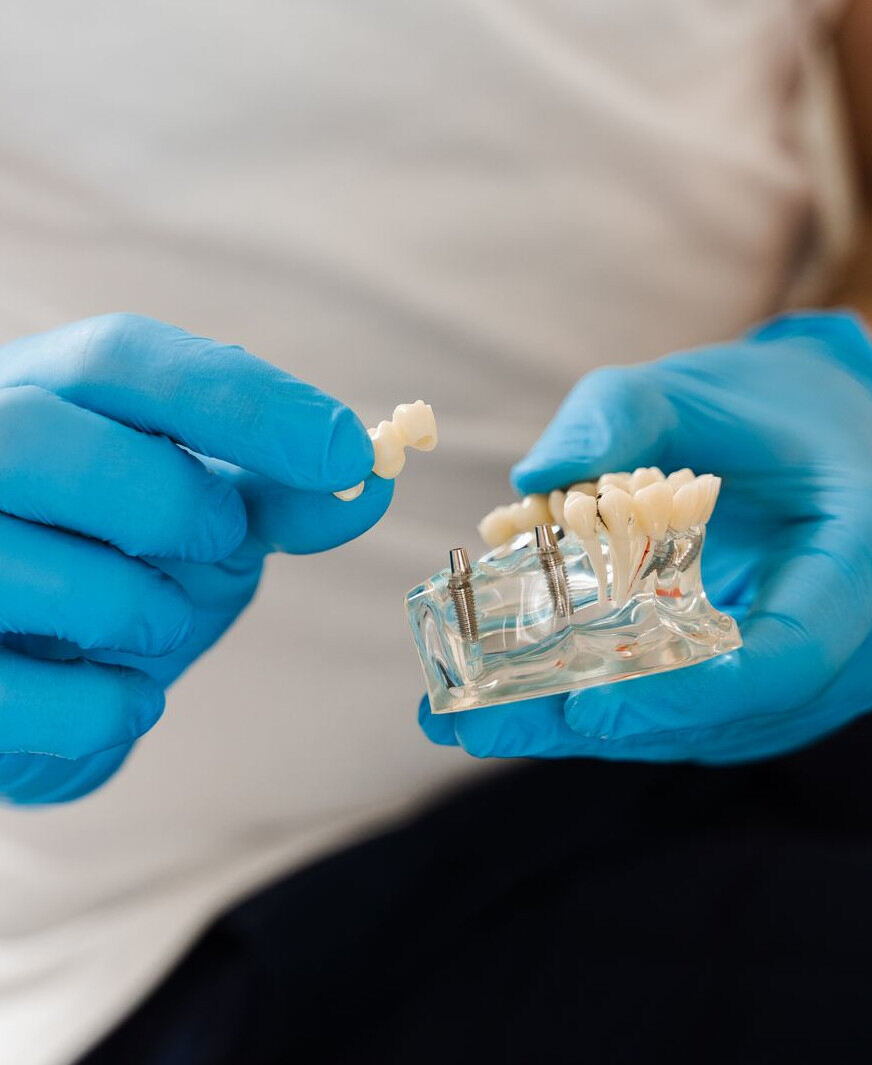 Dental Implants Services Dental Implants in Toronto Canada